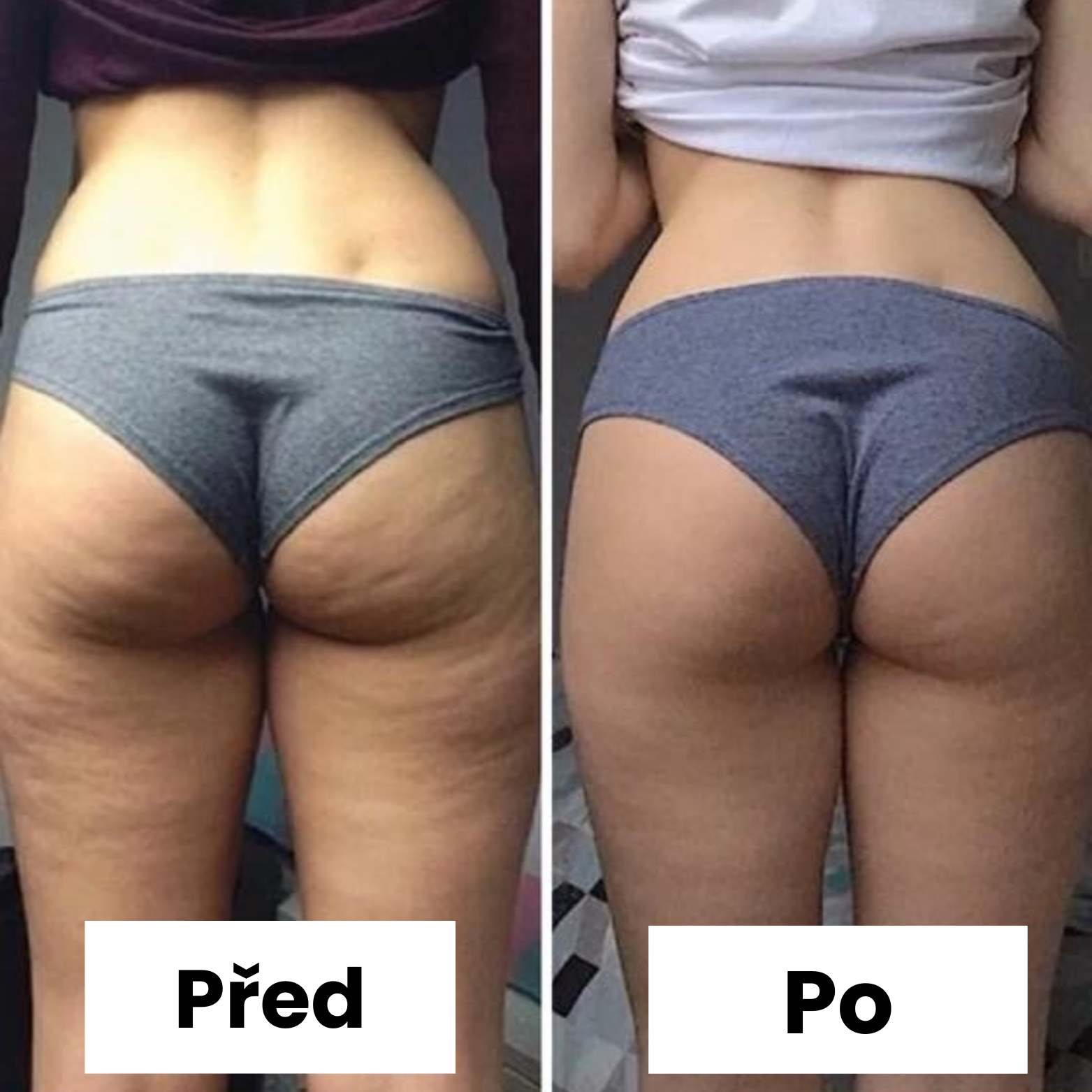 Masážní Olej Proti Celulitidě